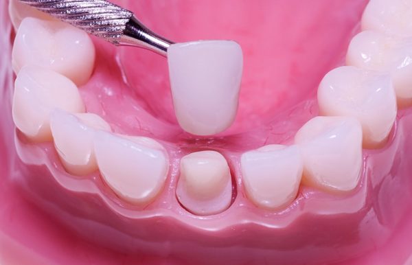 Bọc răng sứ là phương pháp được đa phần người nổi tiếng làm vì độ đều và đẹp của răng sứ đem đến Bọc răng sứ là phương pháp được đa phần người nổi tiếng làm vì độ đều và đẹp của răng sứ đem đến