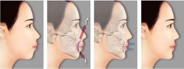 Chỉnh nha đem lại vẻ đẹp hoàn hảo cho răng hàm mặt Chỉnh nha đem lại vẻ đẹp hoàn hảo cho răng hàm mặt