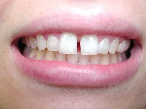 Răng thưa nhẹ cũng có thể dùng phương pháp trám răng cửa để cải thiện vấn đề giúp lấy lại sự tự tin.