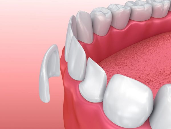 Dán răng sứ có nhiều ưu điểm nổi bật Dán răng sứ có nhiều ưu điểm nổi bật