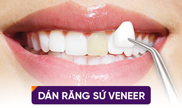 Dán răng sứ có bền hay không phụ thuộc vào những yếu tố trên