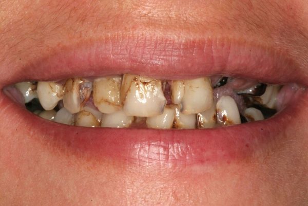Răng sâu sẽ làm răng lợi và nụ cười của bạn trở nên kém duyên, kém thẩm mỹ