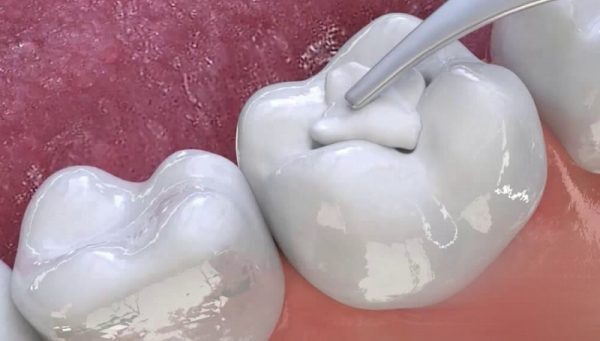 Nha khoa Platinum là nha khoa hàng đầu trong lĩnh vực nha khoa nói chung và hàn răng sâu, chữa sâu răng nói riêng.