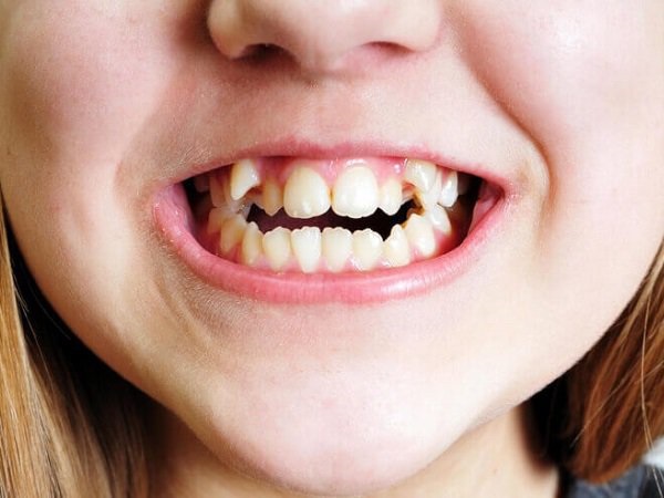 Tuy nhiên có những chiếc răng khểnh lệch quá nhiều làm gương mặt mất cân đối và ảnh hưởng đến việc ăn nhai.