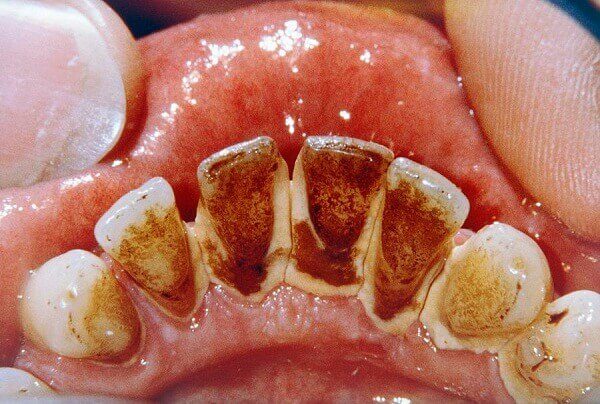 Răng bị sâu đen mất thẩm mỹ Răng bị sâu đen mất thẩm mỹ