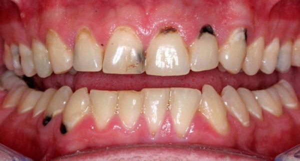 Tình trạng răng bị sâu đen Tình trạng răng bị sâu đen