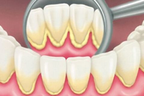 Răng bị cao răng, mảng bám lâu ngày không vệ sinh Răng bị cao răng, mảng bám lâu ngày không vệ sinh