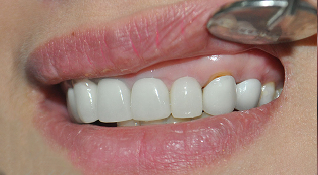 Tình trạng răng đen do mão sứ