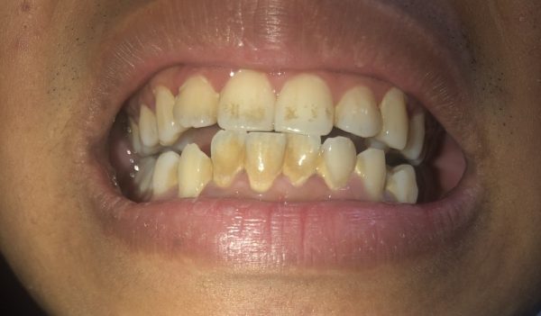 Việc răng cửa khập khểnh gây ảnh hưởng đến ăn nhai và quá trình vệ sinh răng miệng làm răng bị xỉn màu, ố vàng.