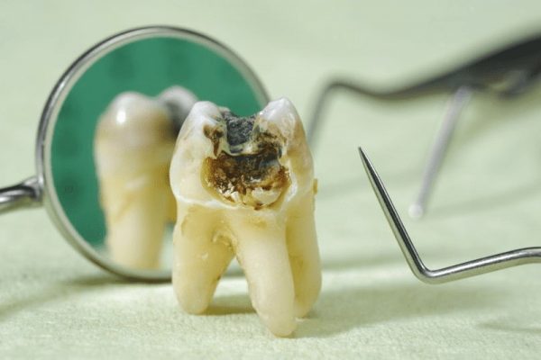 Phần răng khôn bị sâu vỡ dễ chuyển sang màu khác, vỡ ra thành các cạnh sắt dễ tứa vào răng lợi gây khó chịu cho người bệnh. Phần răng khôn bị sâu vỡ dễ chuyển sang màu khác, vỡ ra thành các cạnh sắt dễ tứa vào răng lợi gây khó chịu cho người bệnh.