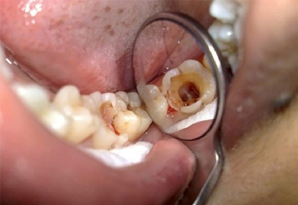 Nếu không có biện pháp xử lý sớm, sâu răng số 8 có thể gây vỡ răng, dẫn đến nhiều bệnh lý răng miệng nguy hiểm khác.