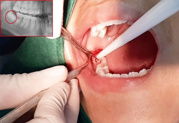 Các bác sĩ sẽ xem xét và đề nghị bạn nhổ răng số 8 nếu như tình trạng sâu quá nặng tránh lây lan sang những răng khác.
