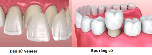 Sự khác nhau của dán răng sứ và bọc răng sứ Sự khác nhau của dán răng sứ và bọc răng sứ