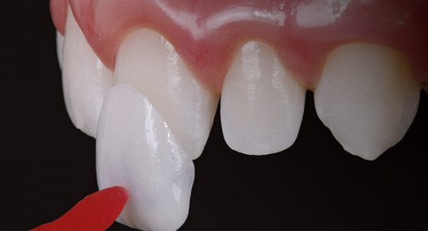 Dán răng sứ khá phổ biến dành cho răng bị hư tổn tương đối Dán răng sứ khá phổ biến dành cho răng bị hư tổn tương đối