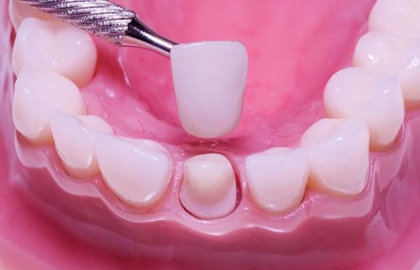 Phương pháp bọc răng sứ giúp chỉnh nha hiệu quả ở hầu hết trường hợp.