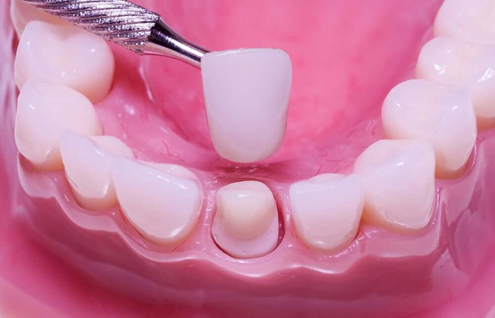 Phương pháp bọc răng sứ giúp chỉnh nha hiệu quả ở hầu hết trường hợp.