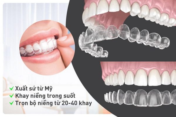 Chi phí khá đắt đỏ chính là nhược điểm lớn nhất của phương pháp niềng răng Invisalign. Chi phí khá đắt đỏ chính là nhược điểm lớn nhất của phương pháp niềng răng Invisalign.