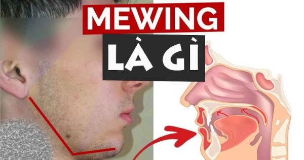 Mewing được biết đến là phương pháp làm thon gọn, thanh thoát hơn cho hàm mặt rất hiệu quả ở các nước Âu, Mỹ.