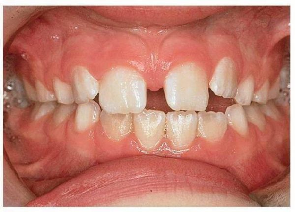 Tư thế đặt lưỡi sao kéo dài có thể là một trong những nguyên nhân khiến cho răng bị thưa và tình trạng nghiêm trọng hơn theo thời gian.