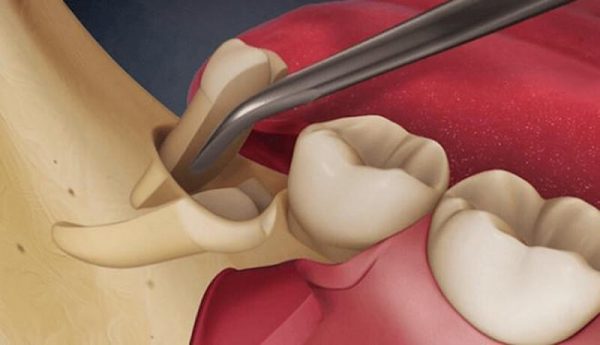 Xuất hiện lỗ hổng sau khi nhổ răng là tình trạng rất thường gặp và không quá nguy hiểm