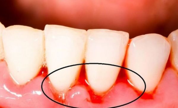 Không nên dùng tăm tre hoặc các vật cứng vì chúng dễ gây tổn thương đến những mô nướu đang trong quá trình lành Không nên dùng tăm tre hoặc các vật cứng vì chúng dễ gây tổn thương đến những mô nướu đang trong quá trình lành