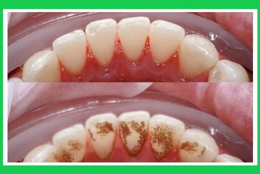 Ba tháng giữa thai kỳ là thời điểm tốt nhất để lấy cao răng ở phụ nữ mang thai Ba tháng giữa thai kỳ là thời điểm tốt nhất để lấy cao răng ở phụ nữ mang thai