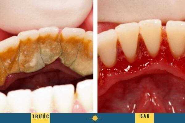 Sau khi lấy cao răng, các mẹ cũng cần lưu ý và duy trì chế độ chăm sóc răng miệng đầy đủ, đúng cách Sau khi lấy cao răng, các mẹ cũng cần lưu ý và duy trì chế độ chăm sóc răng miệng đầy đủ, đúng cách