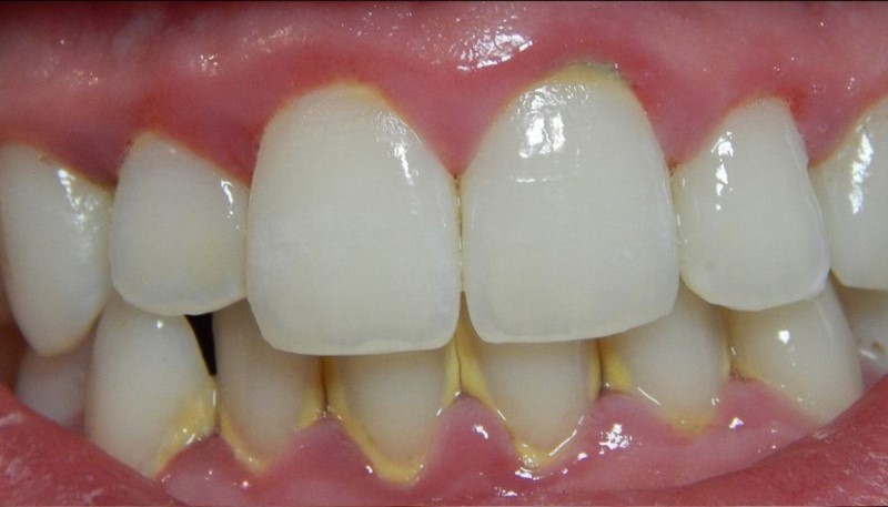 Mảng bám là một trong những tác nhân chính gây ăn mòn men răng với nhiều axit có trong đây. Mảng bám là một trong những tác nhân chính gây ăn mòn men răng với nhiều axit có trong đây.