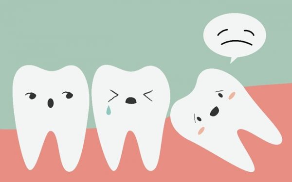 Một số điều cần biết khi mọc răng khôn 