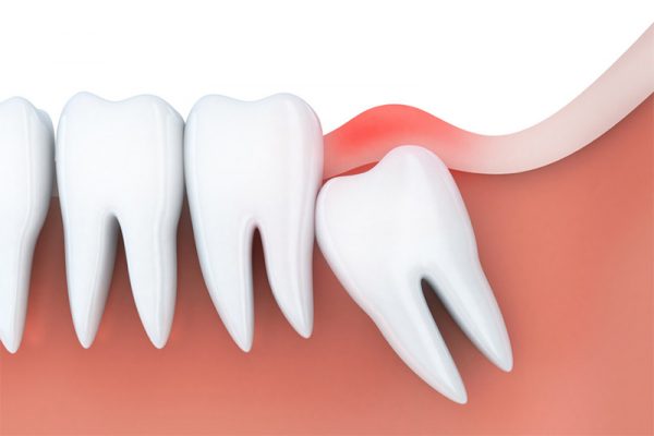 Răng khôn nên nhổ bỏ hay giữ lại điều trị khi đau? 