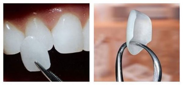 Với phương pháp dán Veneer thì răng chỉ cần mài một lớp mỏng để làm điểm tựa cho mặt dán thêm chắc và ổn định.