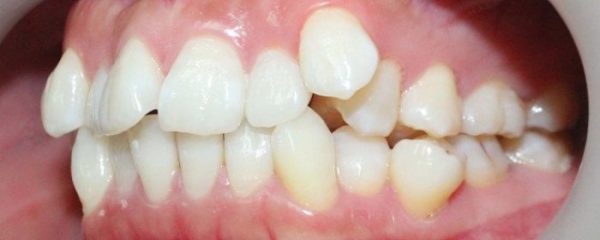 Bệnh cạnh phương pháp niềng răng cho những trường hợp răng mọc lệch thì người dùng có thể lựa chọn phương thức khác với hiệu quả nhanh hơn. Bệnh cạnh phương pháp niềng răng cho những trường hợp răng mọc lệch thì người dùng có thể lựa chọn phương thức khác với hiệu quả nhanh hơn.