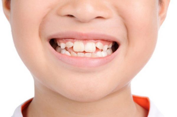 Tình trạng răng cửa to, răng hô hay lệch thì có thể sử dụng phương thức bọc sứ thay vì niềng để cho kết quả nhanh chóng. Tình trạng răng cửa to, răng hô hay lệch thì có thể sử dụng phương thức bọc sứ thay vì niềng để cho kết quả nhanh chóng.