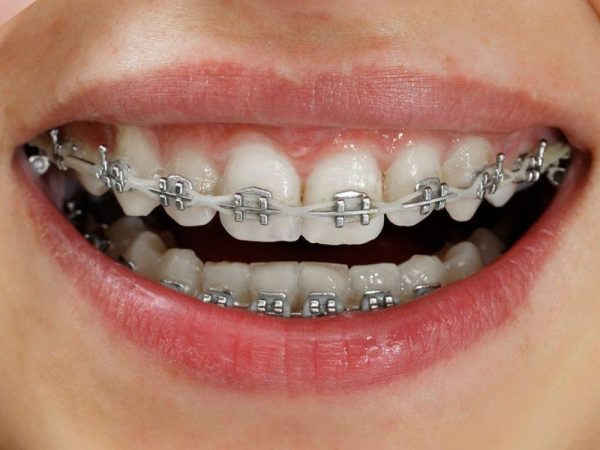 Niềng răng mặc dù không xâm lấn quá nhiều đến răng như sử dụng khí cụ gây mất thẩm mỹ cũng như thời gian lâu. Niềng răng mặc dù không xâm lấn quá nhiều đến răng như sử dụng khí cụ gây mất thẩm mỹ cũng như thời gian lâu.