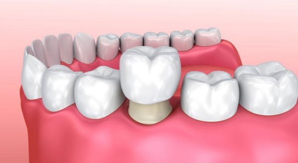 Bọc răng sứ là giải pháp tối ưu cho những trường hợp răng mọc lệch, răng thưa… với thời gian nhanh chóng và tiết kiệm chi phí. Bọc răng sứ là giải pháp tối ưu cho những trường hợp răng mọc lệch, răng thưa… với thời gian nhanh chóng và tiết kiệm chi phí.