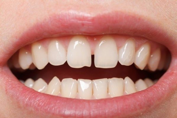 Răng cửa vừa to và vừa bị hở gây mất thẩm mỹ khá nhiều. Bên cạnh đó còn là ảnh hưởng đến khả năng nhai. Răng cửa vừa to và vừa bị hở gây mất thẩm mỹ khá nhiều. Bên cạnh đó còn là ảnh hưởng đến khả năng nhai.