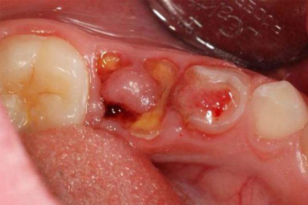 Răng sâu vỡ chỉ còn chân răng có thể khiến những chiếc răng khác trên hàm bị ảnh hưởng nghiêm trọng Răng sâu vỡ chỉ còn chân răng có thể khiến những chiếc răng khác trên hàm bị ảnh hưởng nghiêm trọng