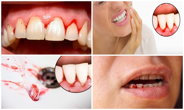 Sâu răng còn có thể gây chảy máu chân răng, lợi dễ bị sưng viêm, đau nhức Sâu răng còn có thể gây chảy máu chân răng, lợi dễ bị sưng viêm, đau nhức