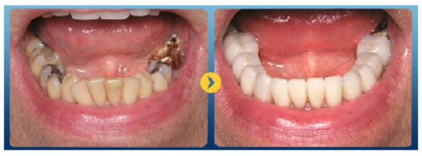 Bọc sứ cho răng sâu bị vỡ chỉ còn chân răng là sự lựa chọn được nhiều chuyên gia lựa chọn Bọc sứ cho răng sâu bị vỡ chỉ còn chân răng là sự lựa chọn được nhiều chuyên gia lựa chọn