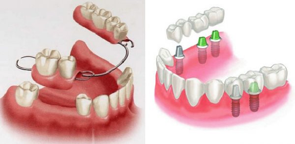 Khi răng sâu quá nghiêm trọng không còn khả năng giữ chân răng, bạn có thể lắp răng giả để thay thế Khi răng sâu quá nghiêm trọng không còn khả năng giữ chân răng, bạn có thể lắp răng giả để thay thế