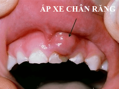 Khi áp xe chân răng bị vỡ, răng sẽ bị chảy máu hoặc đi kèm dịch có mùi hôi Khi áp xe chân răng bị vỡ, răng sẽ bị chảy máu hoặc đi kèm dịch có mùi hôi