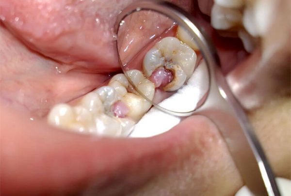 Sâu răng lồi thịt còn có thể làm ảnh hưởng đến những chiếc răng còn lại, gây viêm nhiễm và hoại tử Sâu răng lồi thịt còn có thể làm ảnh hưởng đến những chiếc răng còn lại, gây viêm nhiễm và hoại tử