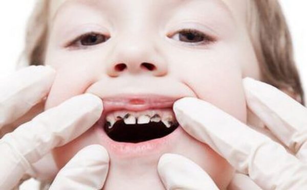 Sâu răng là bệnh lý thường gặp ở hầu hết mọi người, tuy nhiên phổ biến nhất là ở trẻ em
