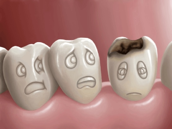 Răng sâu không thể tự lành mà cần được can thiệp điều trị kịp thời và tránh gây ảnh hưởng đến những chiếc răng còn lại 