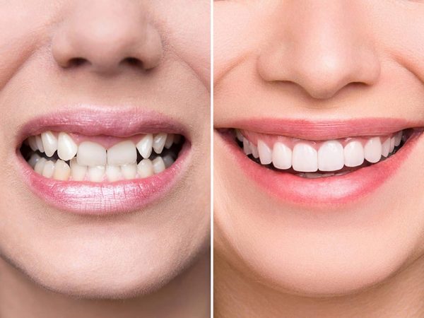 Bọc răng sứ còn có thể điều chỉnh nhiều tình trạng răng khấp khểnh, răng không đều màu.