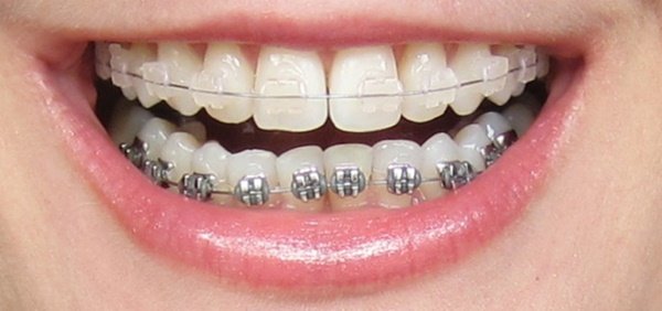 Niềng răng là phương pháp chỉnh nha an toàn tuy nhiên bạn cần phải tốn nhiều thời gian đeo niềng.