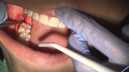 Nhổ sót chân răng có thể đến từ nhiều nguyên nhân, bạn nên tìm hiểu kỹ nguyên nhân trước khi có biện pháp can thiệp điều trị