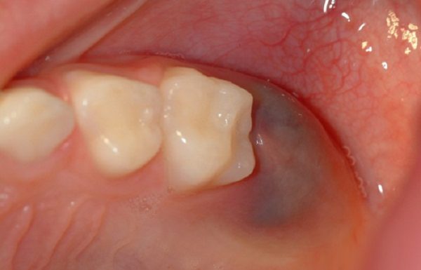 Tay nghề bác sĩ đóng vai trò quan trọng trong việc nhổ loại bỏ răng