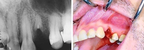 Nhổ sót chân răng có thể gây đau đớn và sưng tấy kéo dài, đây được xem là dấu hiệu dễ nhận biết nhất