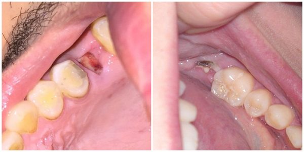 Khi thực hiện các cách nhổ chân răng, các nha sĩ đều phải thực hiện tỉ mỉ, chính xác để tránh gây ra những biến chứng nguy hiểm cho răng